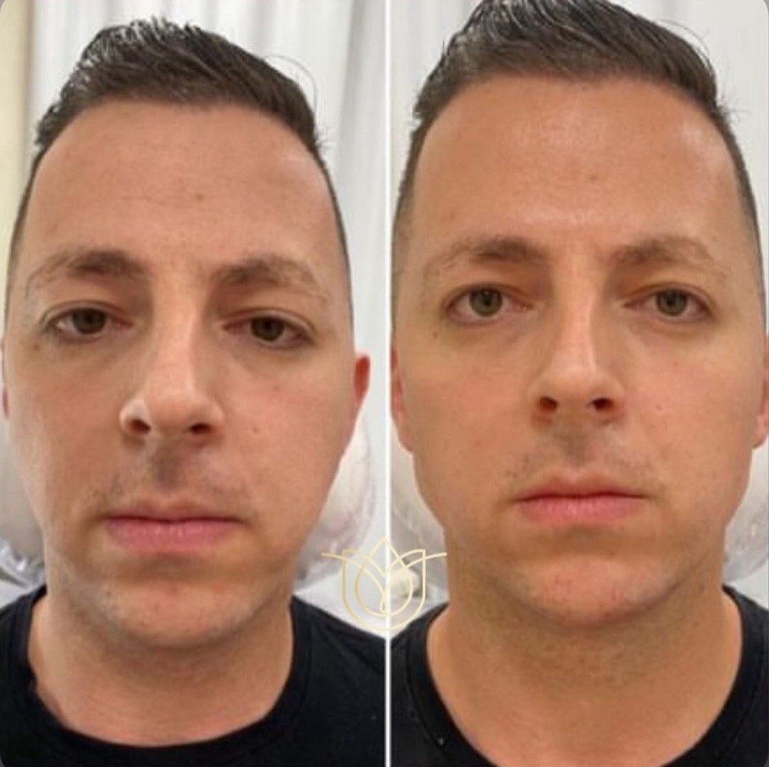Antes e depois de tratamento facial