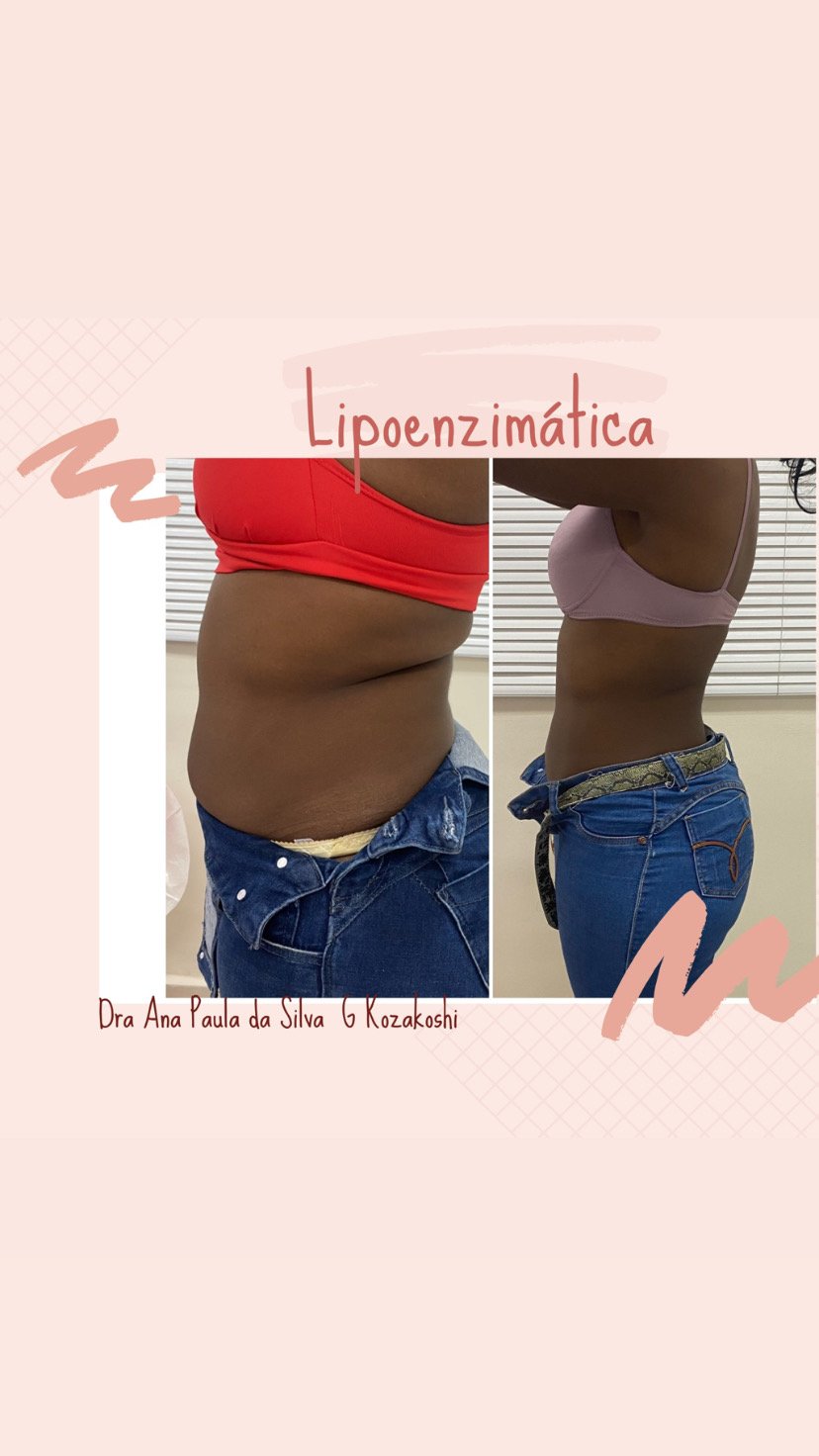 Resultado de lipoenzimática