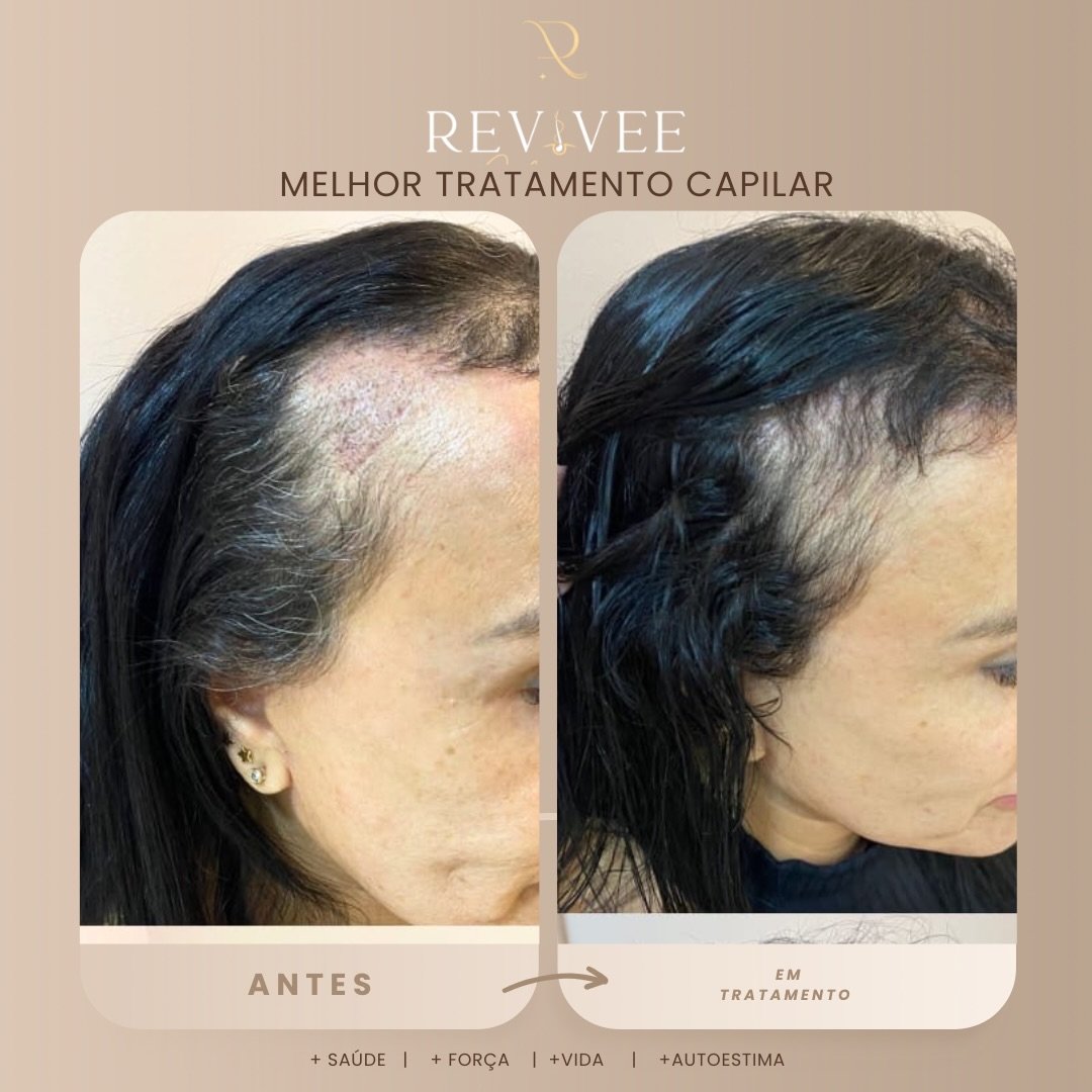 Antes e depois do tratamento Revivee